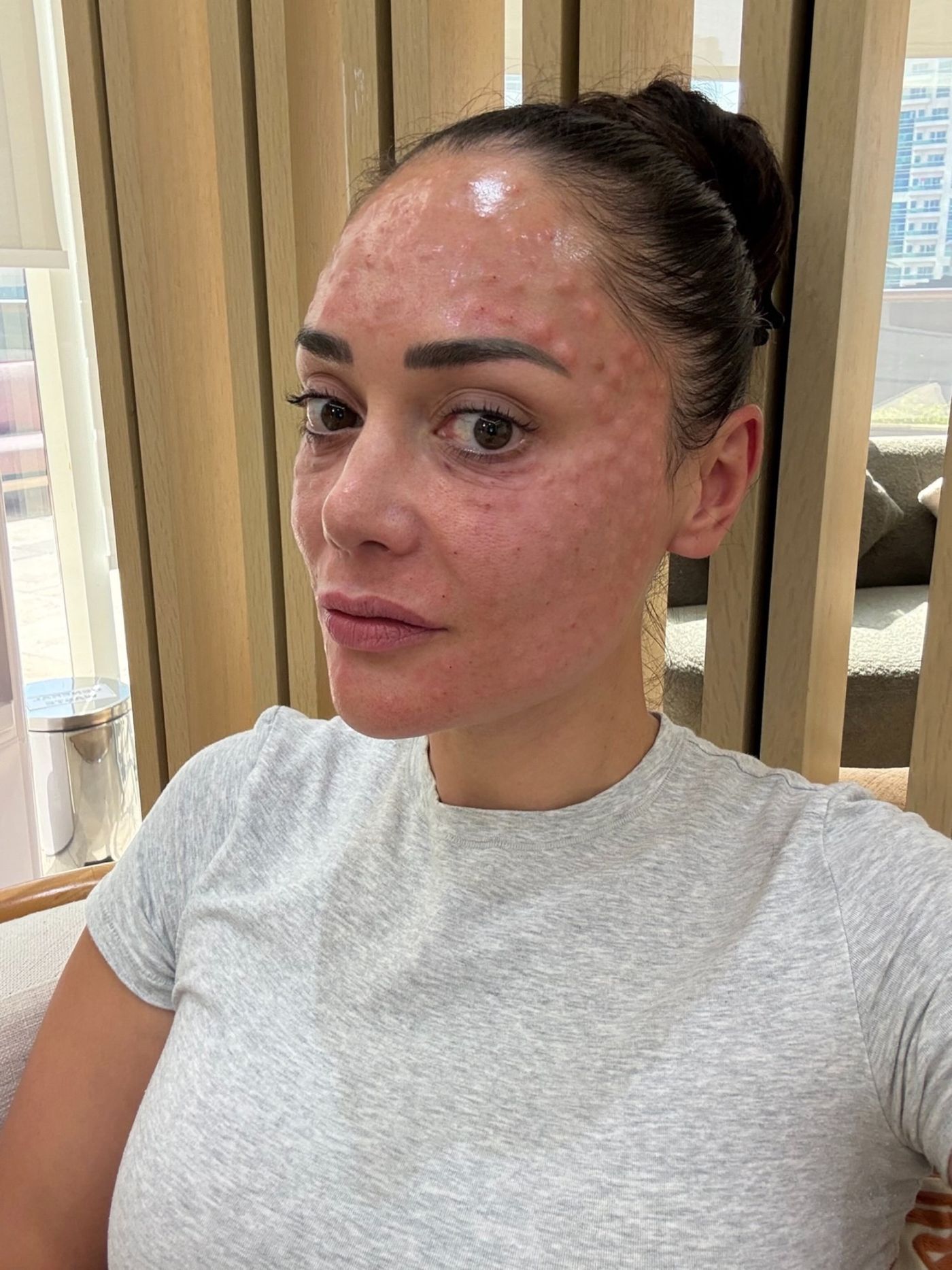 Chelsea Green straight after skin treatment