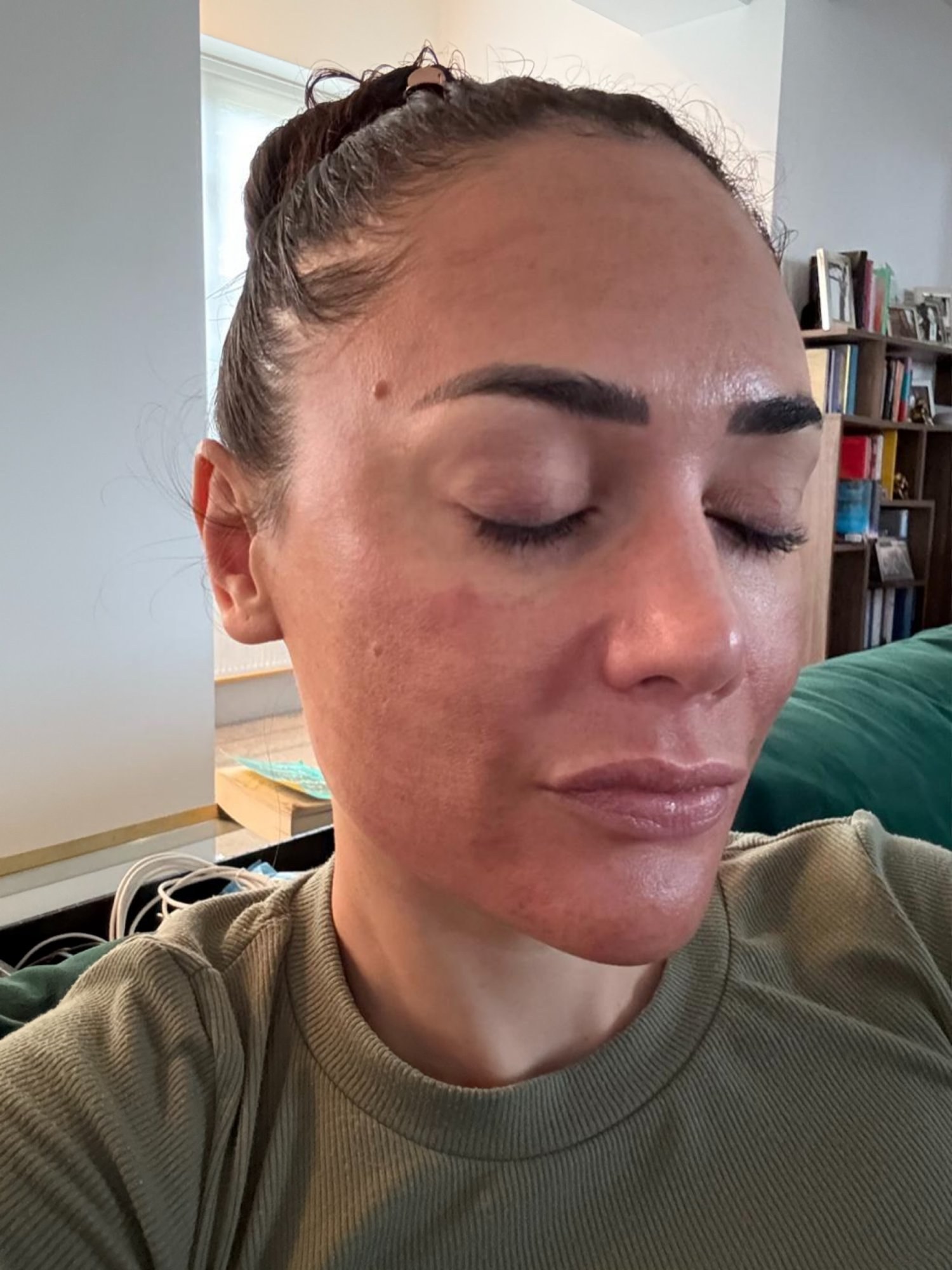 Chelsea Green healing after skin treatment